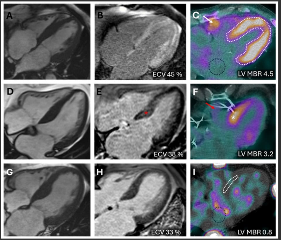 Figure 2 from Validation of [99mTc]Tc-HMDP SPECT/CT myocardium-to-blood ratio for the detection of ATTR cardiomyopathy
